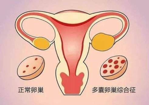 多囊卵巢怎么怀孕