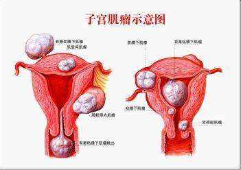 子宫肌瘤症状