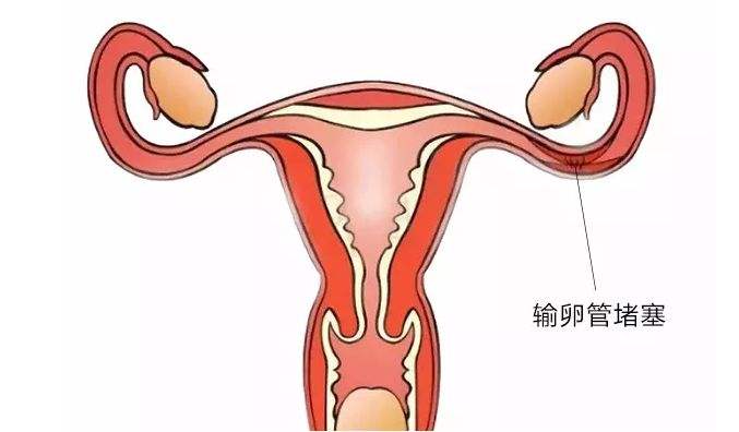 女性单侧输卵管堵塞是否会影响怀孕？输卵管堵塞的症状表现？