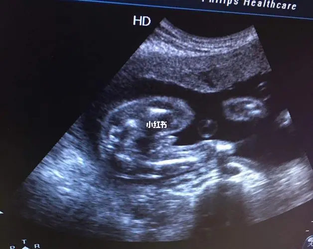 怀孕15周男孩孕彩超图图片
