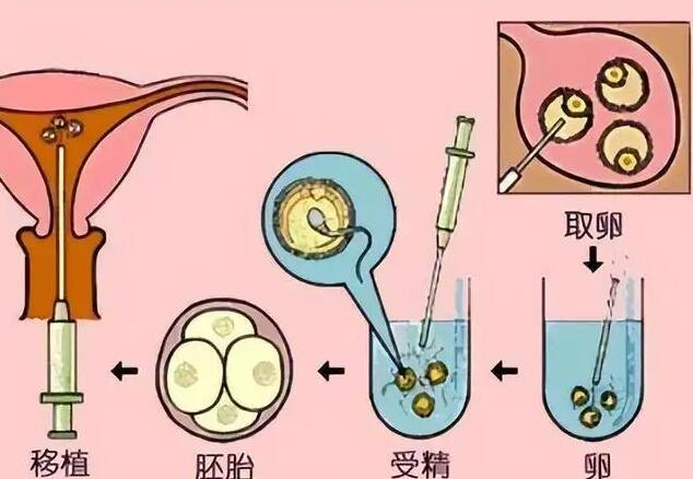 柳州市妇幼保健院供卵生子费用揭密！附最新供卵排队时间