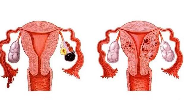 盆腔子宫内膜异位症移植冻囊方案成功率高吗？