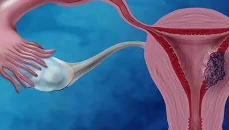 盆腔内膜异位试管胚胎差异大吗？
